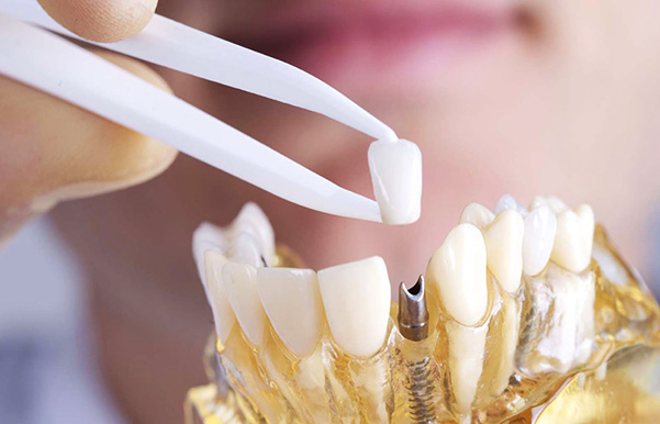 Имплантация зубов: как устанавливают импланты