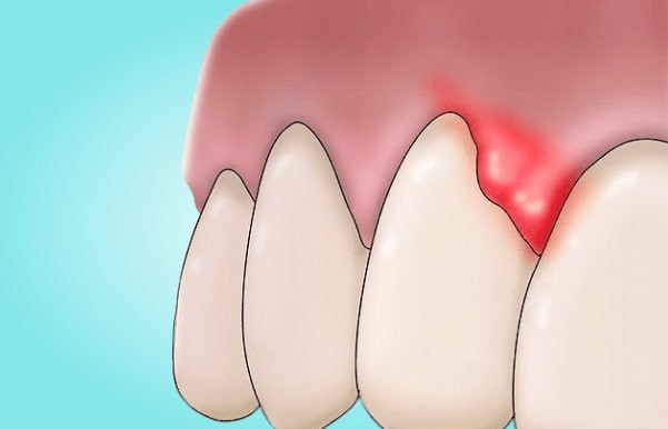 Абсцесс зуба – симптомы, лечение в Балашихе