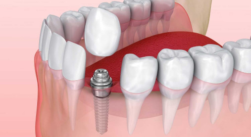 ​Имплантация зубов - это современная и эффективная методика