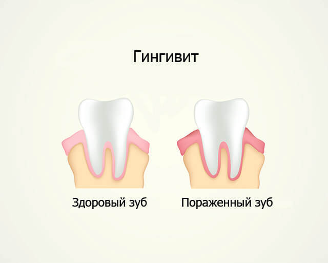Что такое гингивит в стоматологии фото лечение Лечение гингивита в Екатеринбурге недорого МКС Стоматология: причины, классифика